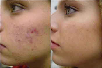 Acne Facial Treatment Skin Services Chandler AZ | Acne Removal Treatment Solution Chandler AZ